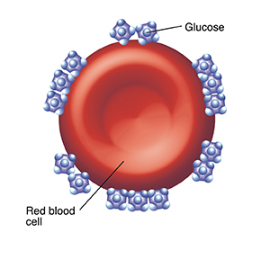 Red blood cell with many glucose molecules stuck to it.