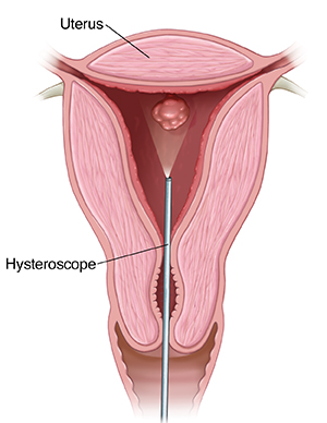 Cross section of uterus showing hysteroscope inside.