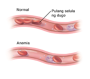 Cross section ng daluyan ng dugo na may normal na dami ng mga pulang selula ng dugo. Sa ibaba nito ay isa pang cross section ng daluyan ng dugo na ipinakikita ang napakakaunting pulang selula ng dugo dahil sa anemia.