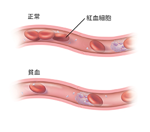 擁有正常紅細胞數量的血管的剖面圖。其下面是血管的另一個剖面圖，顯示了貧血導致的紅細胞過少。